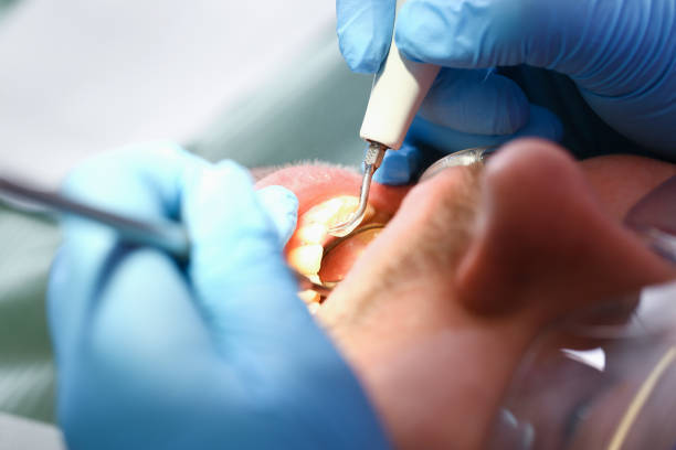 Best Emergency Root Canal Therapy in Salem, IL