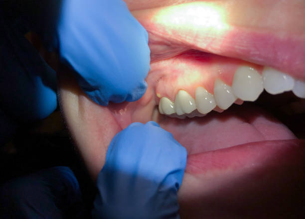 Best Emergency Treatment for Oral Infections in Salem, IL